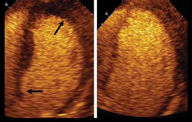 A left ventricle opacification image showing contrast enhancement